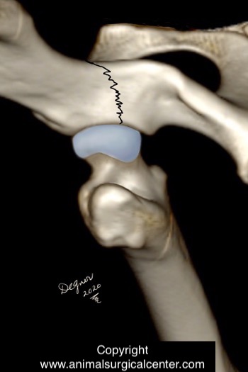 Acetabular fracture 1